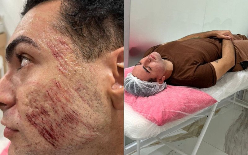 Peeling de fenol: Novas diretrizes do CFM surgem após fatalidade envolvendo paciente e proibição da Anvisa