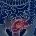 SUS implementa novo teste para detecção precoce do câncer intestinal