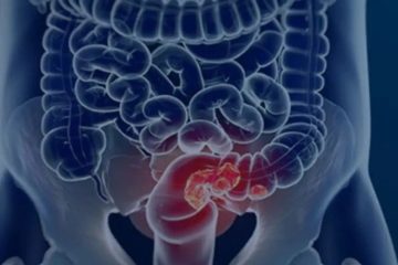 SUS implementa novo teste para detecção precoce do câncer intestinal