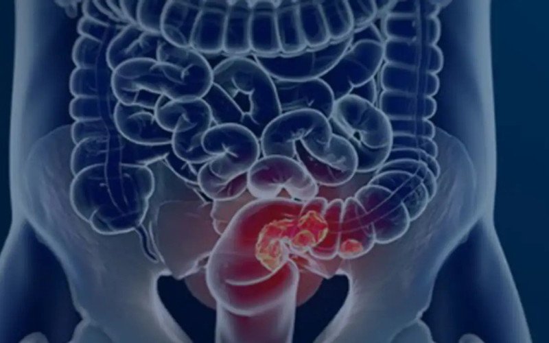 SUS implementa novo teste para detecção precoce do câncer intestinal